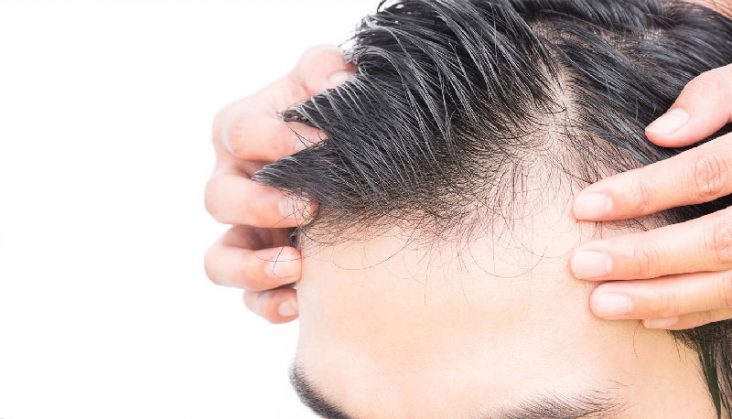 PRP ile saçlı deri tedavisi nasıl uygulanır?